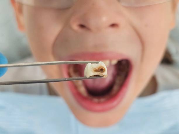 Best Emergency Treatment for Dental Infections or Abscesses in Magnolia, NC